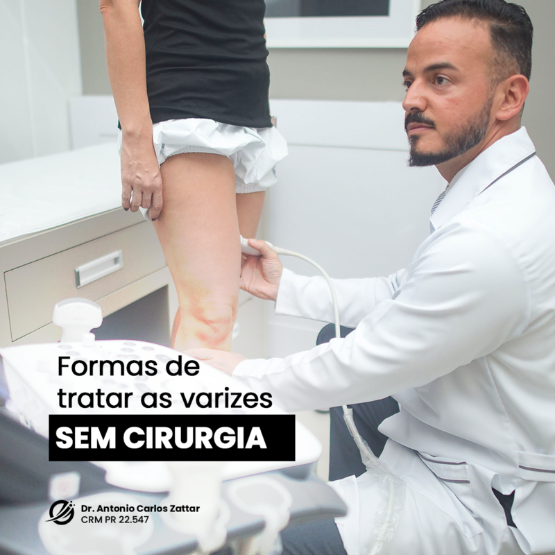 Tratamento de varizes sem cirurgia