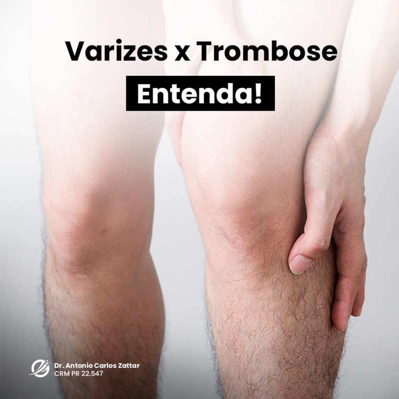 Varizes predispõe a trombose?